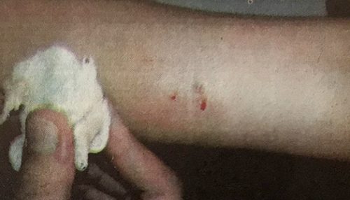 Menina de 9 anos é picada por escorpião dentro de escola em Adamantina