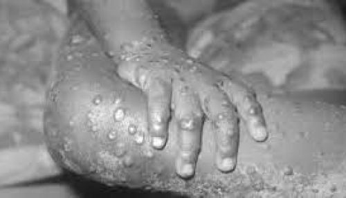 Jovem brasileiro é o primeiro paciente com varíola do macaco na Alemanha