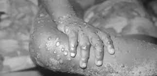 Jovem brasileiro é o primeiro paciente com varíola do macaco na Alemanha