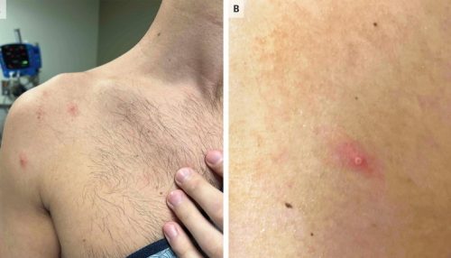 Brasil registra primeira morte por varíola do macaco fora do continente africano