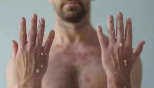 Secretaria de Saúde de Tupã investiga primeiro caso suspeito de varíola dos macacos