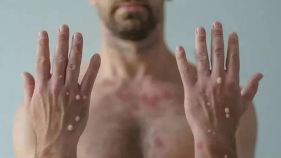 Bauru confirma primeiro caso de varíola dos macacos