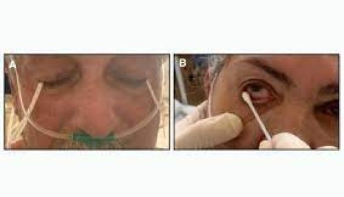 Estudo mostra que COVID-19 pode ser detectado em lágrimas com uso de swab