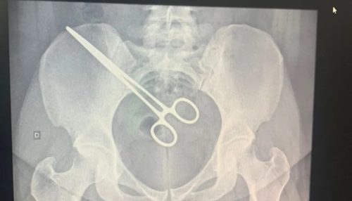 Mulher descobriu pinça cirúrgica esquecida dentro do corpo ao visitar marido em CDP
