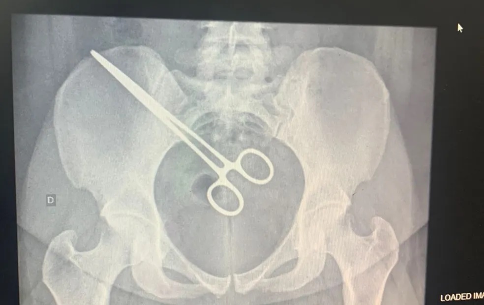 Mulher descobriu pinça cirúrgica esquecida dentro do corpo ao visitar marido em CDP