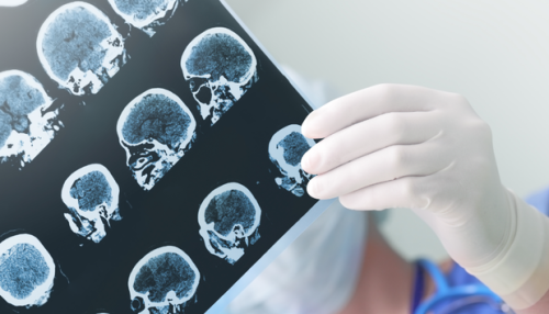 Ministério da Saúde inclui no SUS tratamento para AVC isquêmico