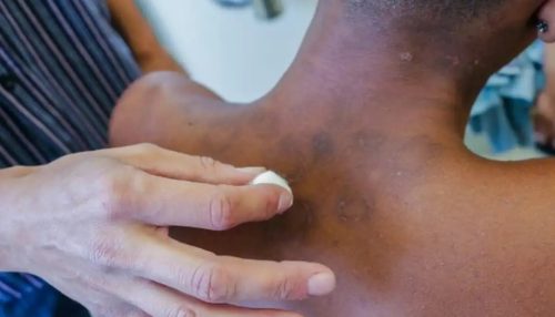 Novos casos de hanseníase aumentaram 5% de janeiro a novembro de 2023